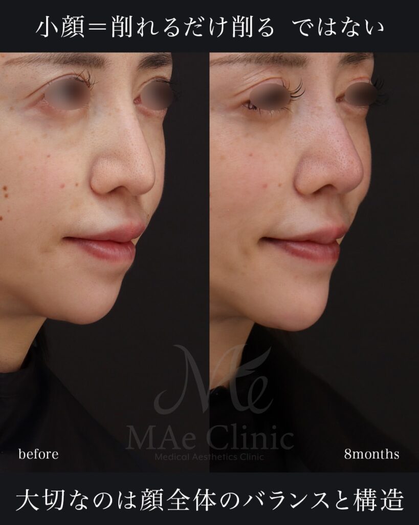 Vライン修正（顎先再建・肋軟骨移植） 鼻中隔延長（肋軟骨） 鼻尖形成・鼻尖軟骨移植 隆鼻術（肋軟骨） 猫貴族手術 前田翔医師症例