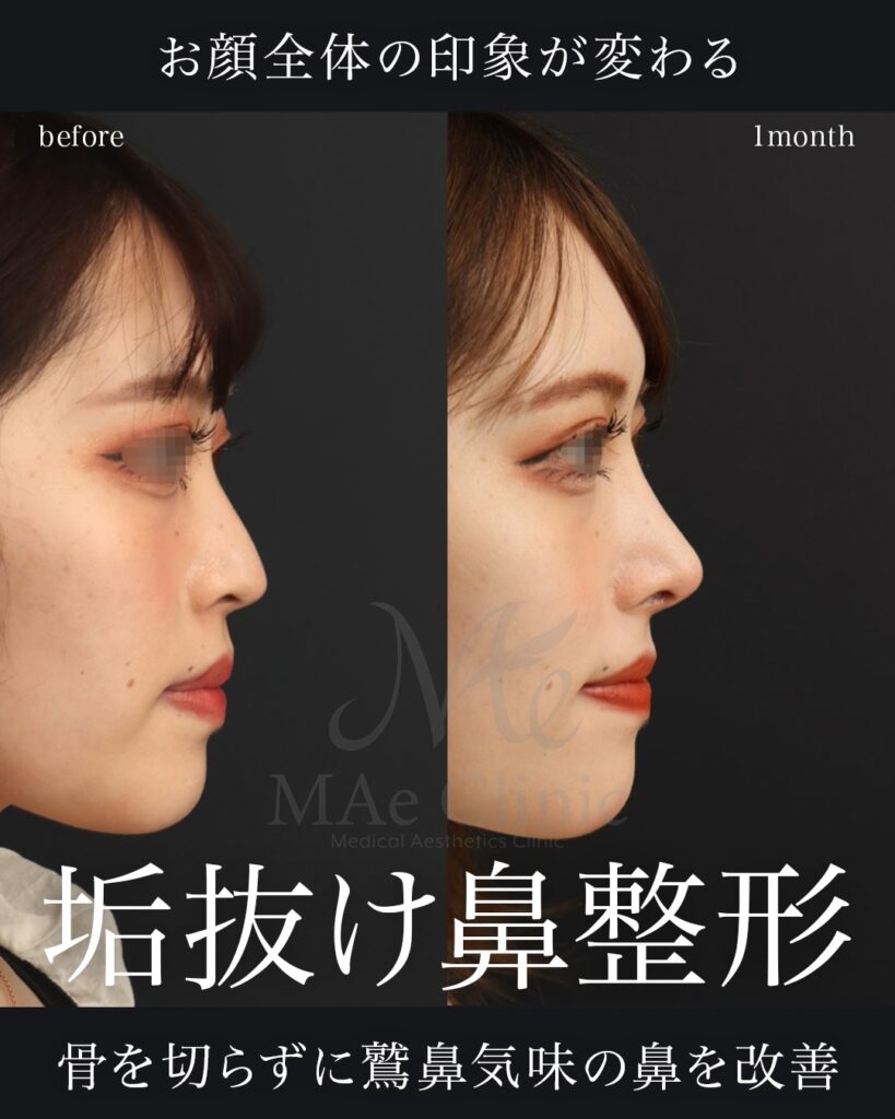 鼻中隔延長 鼻尖形成 鼻尖軟骨移植 隆鼻術（自家軟骨） 前田翔医師症例