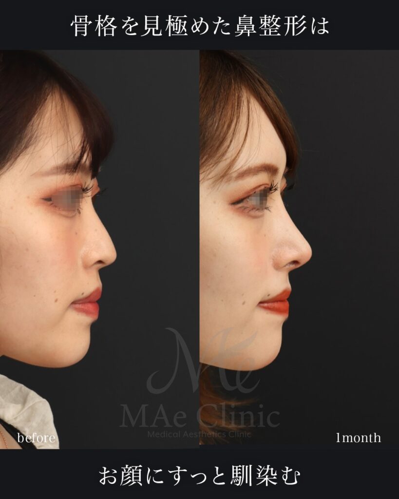 鼻中隔延長 鼻尖形成 鼻尖軟骨移植 隆鼻術（自家軟骨） 前田翔医師症例