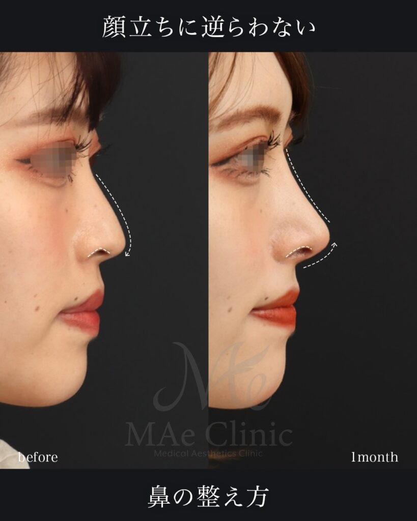 鼻中隔延長 鼻尖形成 鼻尖軟骨移植 隆鼻術（自家軟骨） 前田翔医師症例