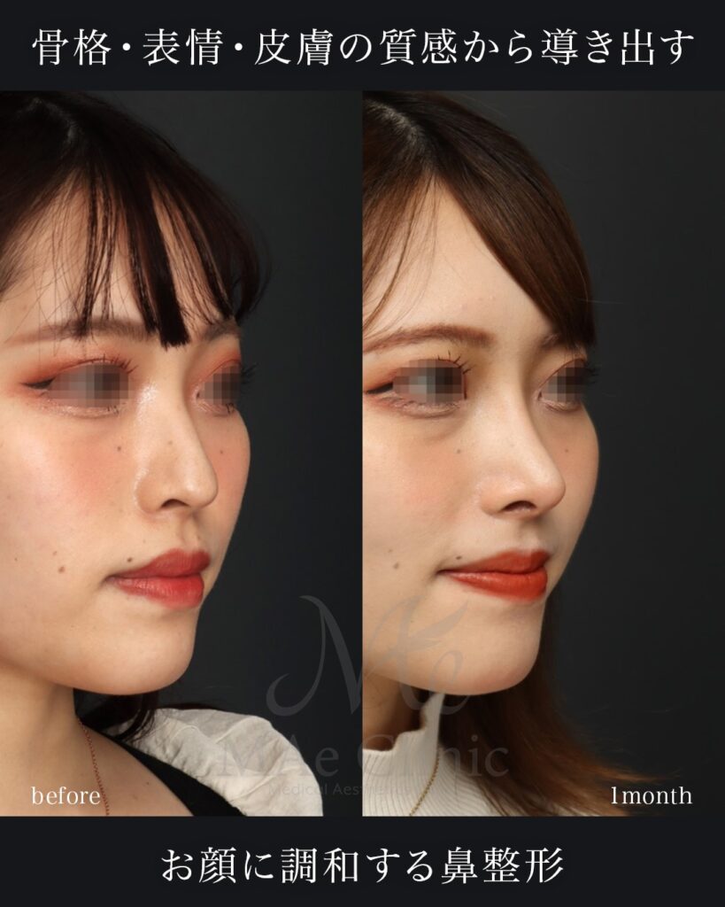 鼻中隔延長 鼻尖形成 鼻尖軟骨移植 隆鼻術（自家軟骨） 前田翔医師症例