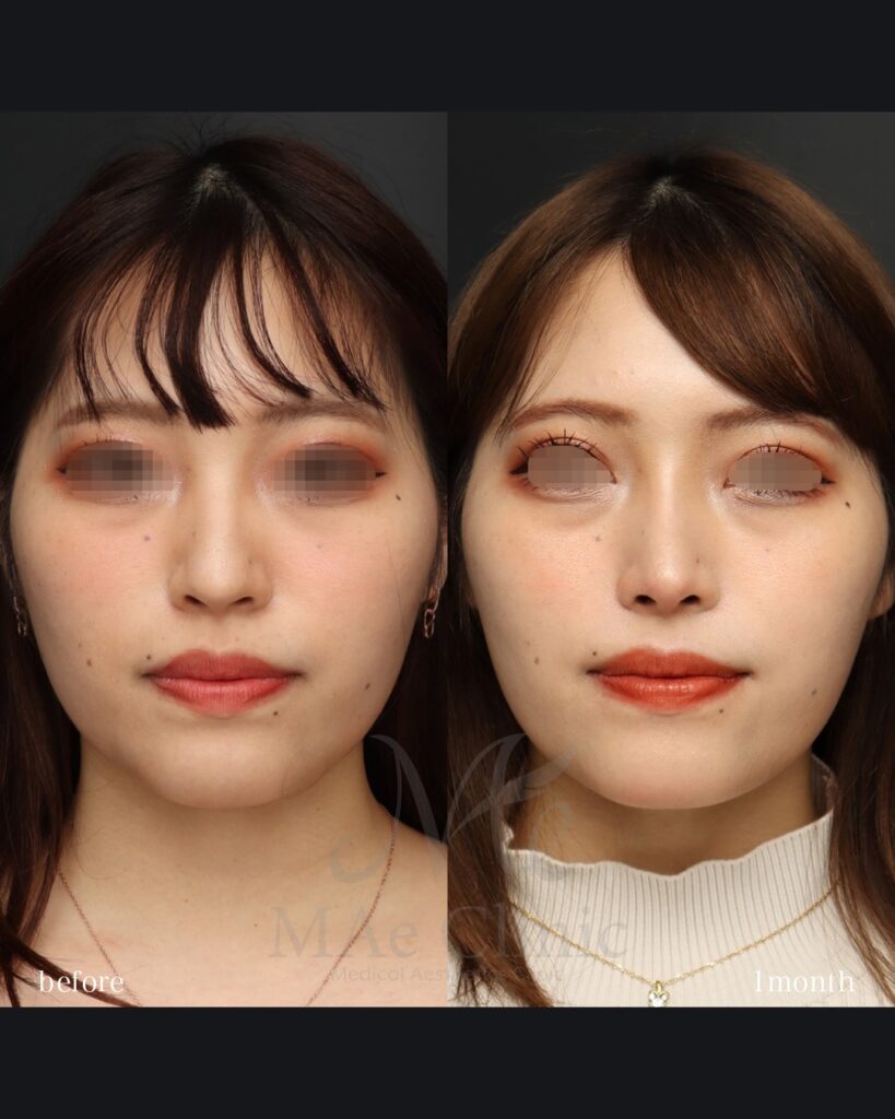 鼻中隔延長 鼻尖形成 鼻尖軟骨移植 隆鼻術（自家軟骨） 前田翔医師症例