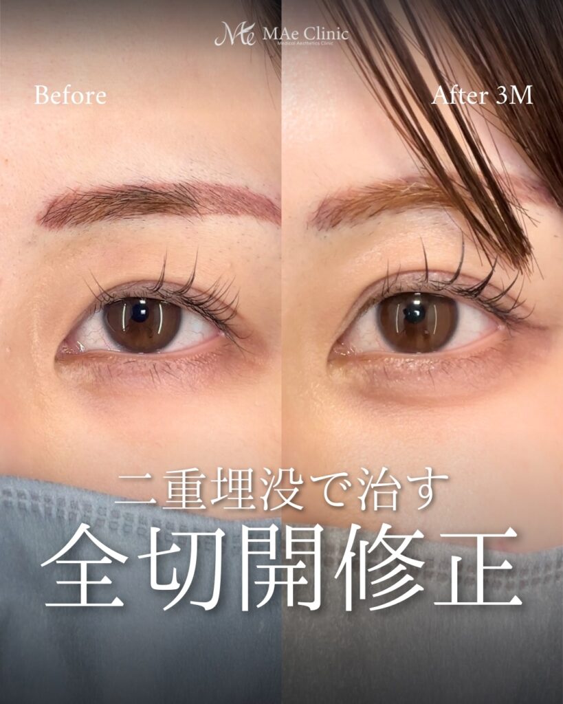 二重埋没法（全切開後の幅広修正）
裏ハムラ
前之園健太医師症例