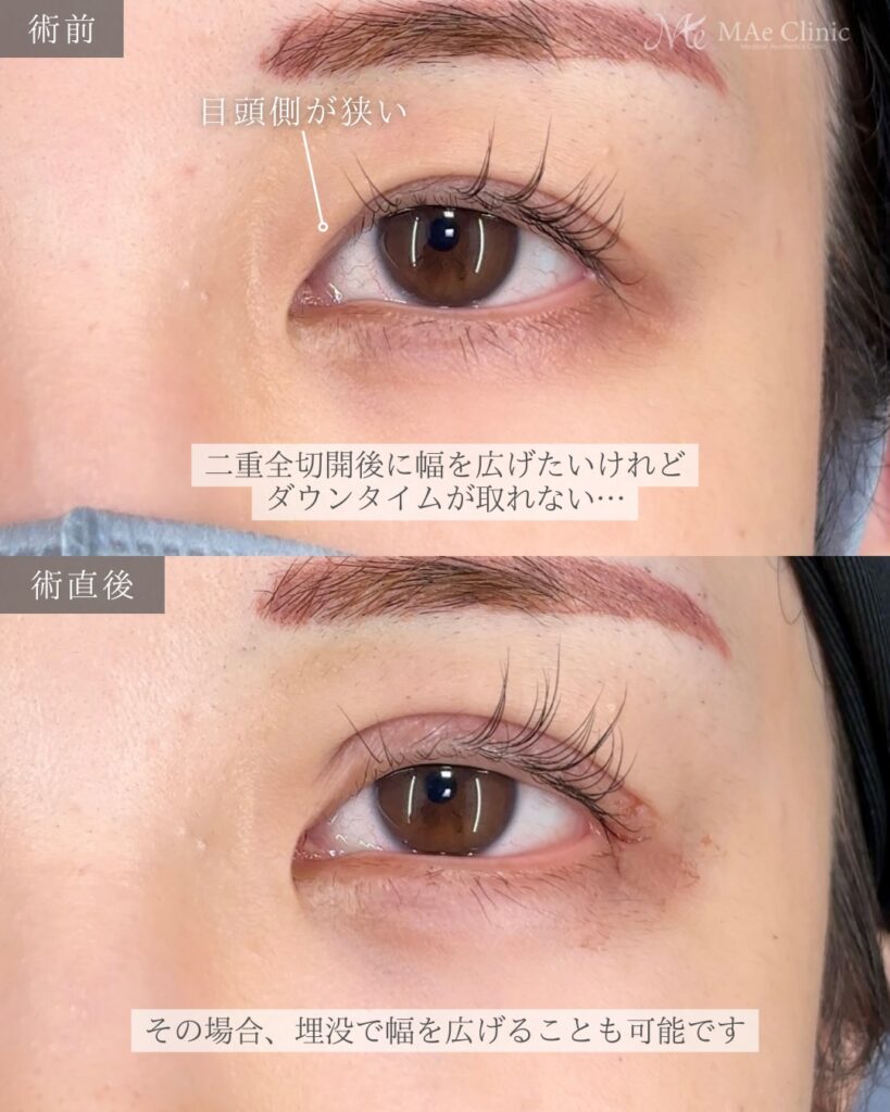 二重埋没法（全切開後の幅広修正） 裏ハムラ 前之園健太医師症例