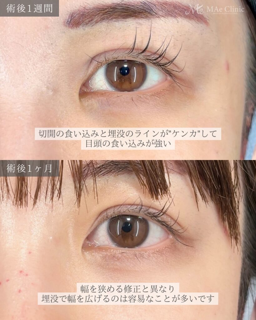 二重埋没法（全切開後の幅広修正） 裏ハムラ 前之園健太医師症例