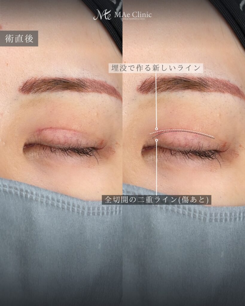 二重埋没法（全切開後の幅広修正） 裏ハムラ 前之園健太医師症例