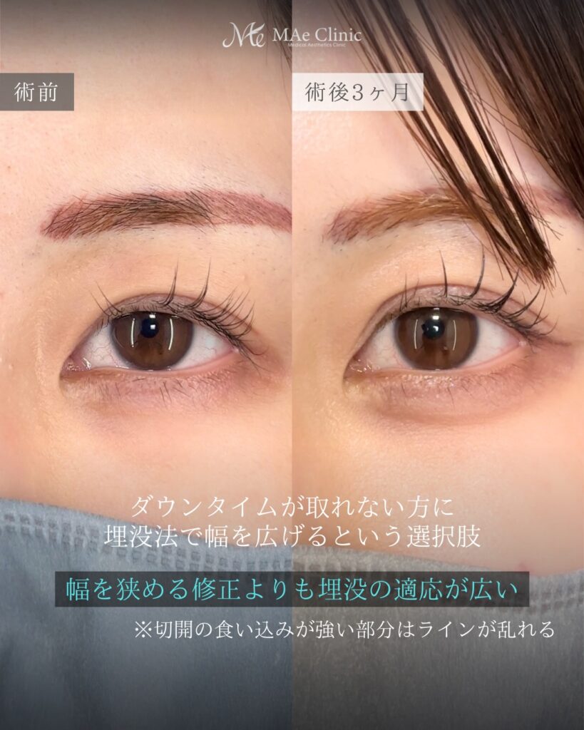 二重埋没法（全切開後の幅広修正） 裏ハムラ 前之園健太医師症例