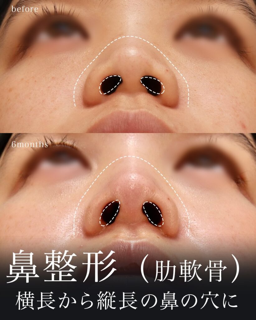鼻中隔延長（肋軟骨） 鼻尖形成 鼻尖軟骨移植 猫貴族手術 望月正人医師症例
