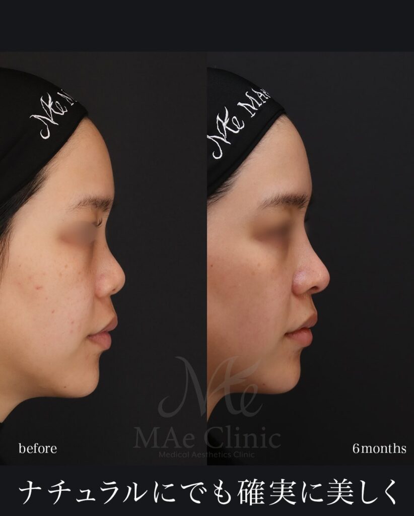 鼻中隔延長(肋軟骨) 鼻尖形成 鼻尖軟骨移植 猫貴族手術 望月正人医師症例