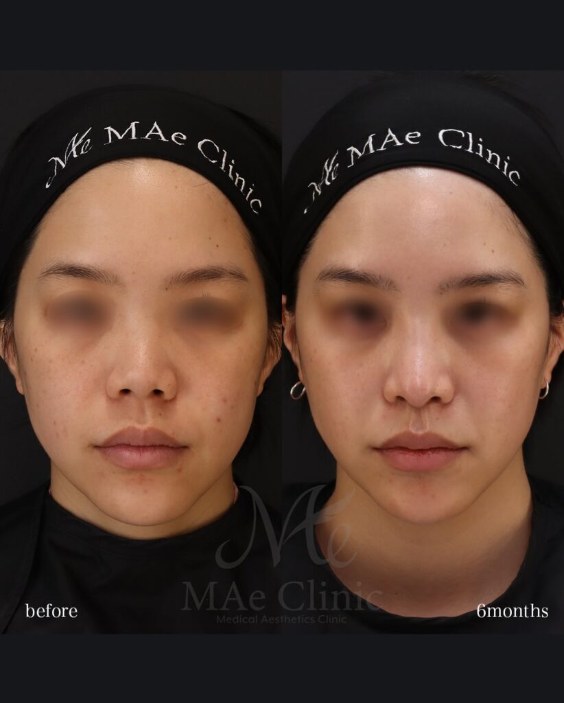 鼻中隔延長(肋軟骨) 鼻尖形成 鼻尖軟骨移植 猫貴族手術 望月正人医師症例