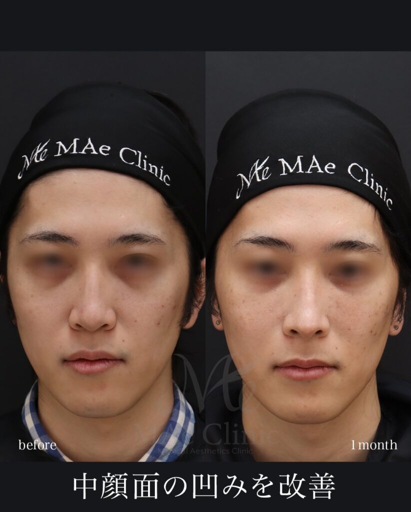 鼻中隔延長(肋軟骨) 鼻尖形成 鼻尖軟骨移植 猫貴族手術 望月正人医師症例