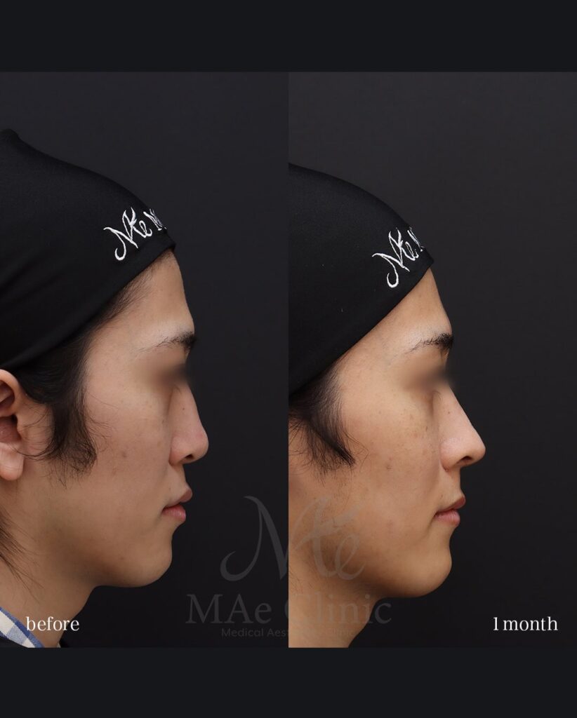 鼻中隔延長(肋軟骨) 鼻尖形成 鼻尖軟骨移植 猫貴族手術 望月正人医師症例