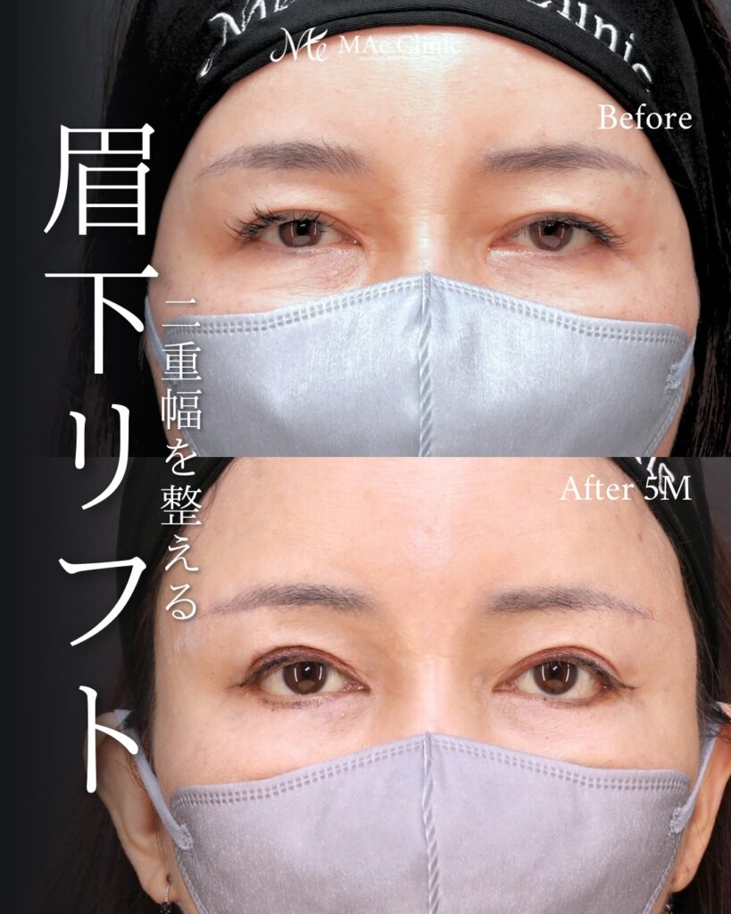 眉下リフト 前之園健太医師症例