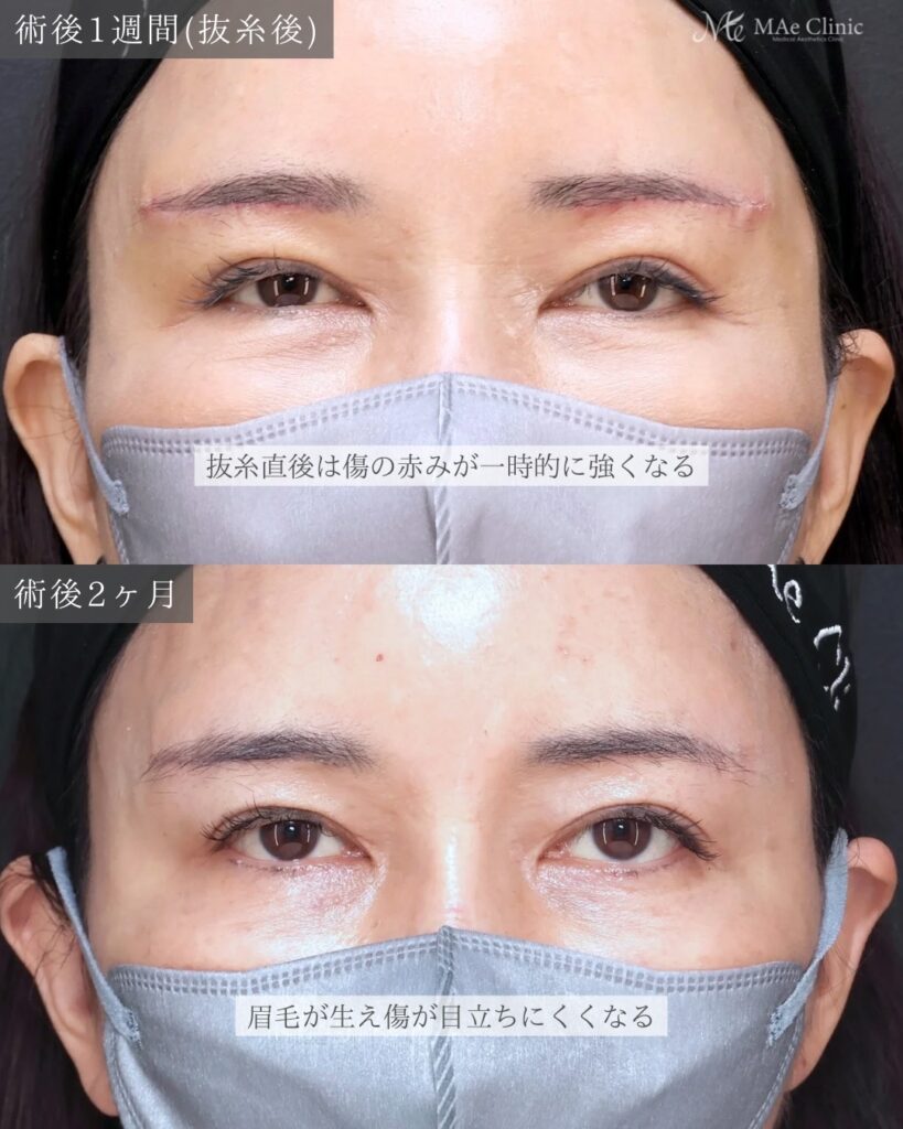 眉下リフト 前之園健太医師症例