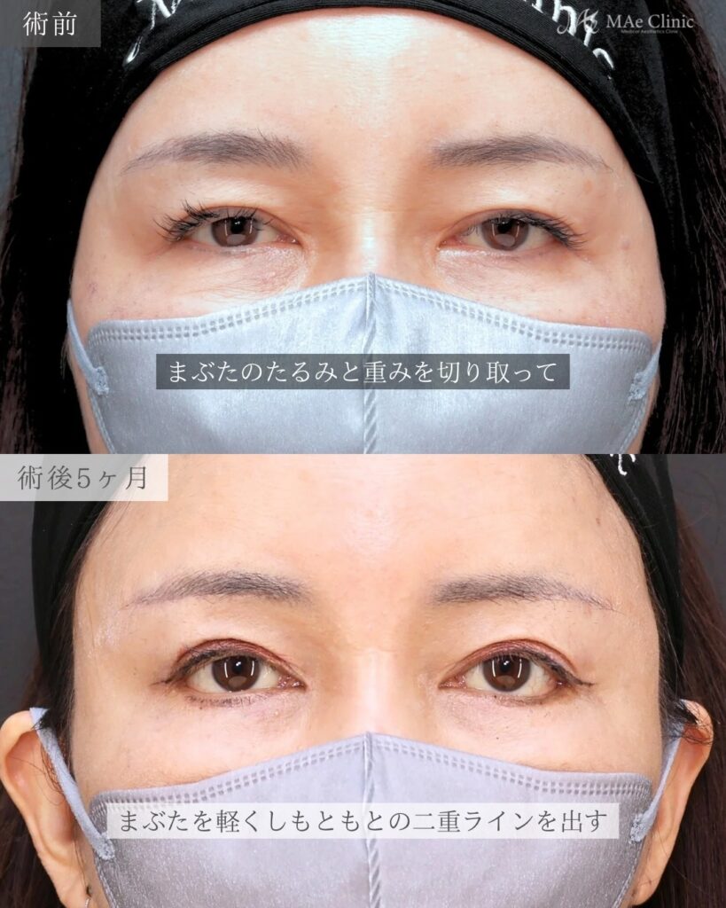 眉下リフト 前之園健太医師症例