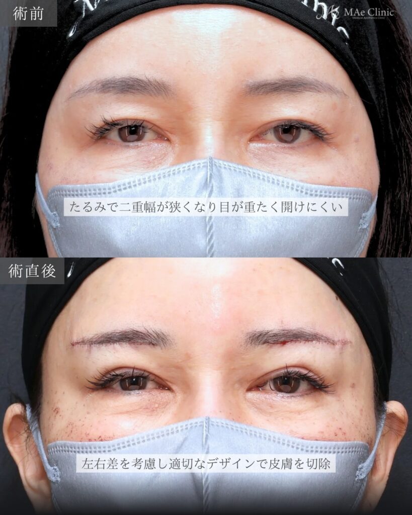 眉下リフト 前之園健太医師症例