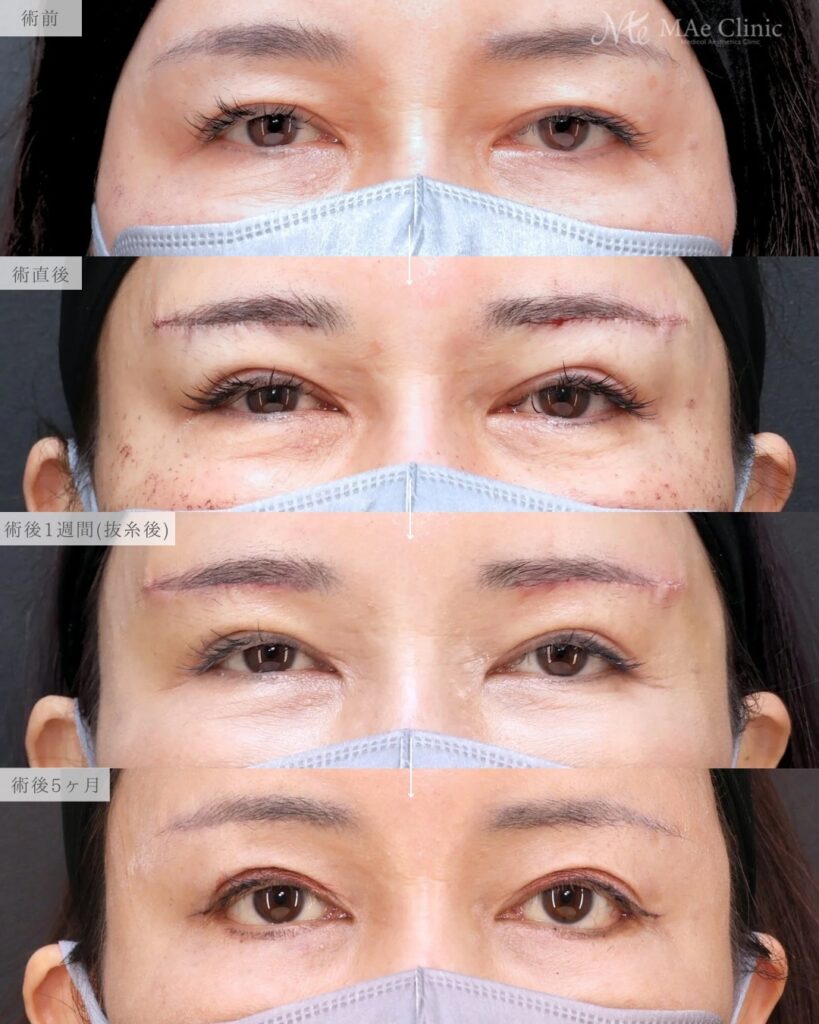 眉下リフト 前之園健太医師症例