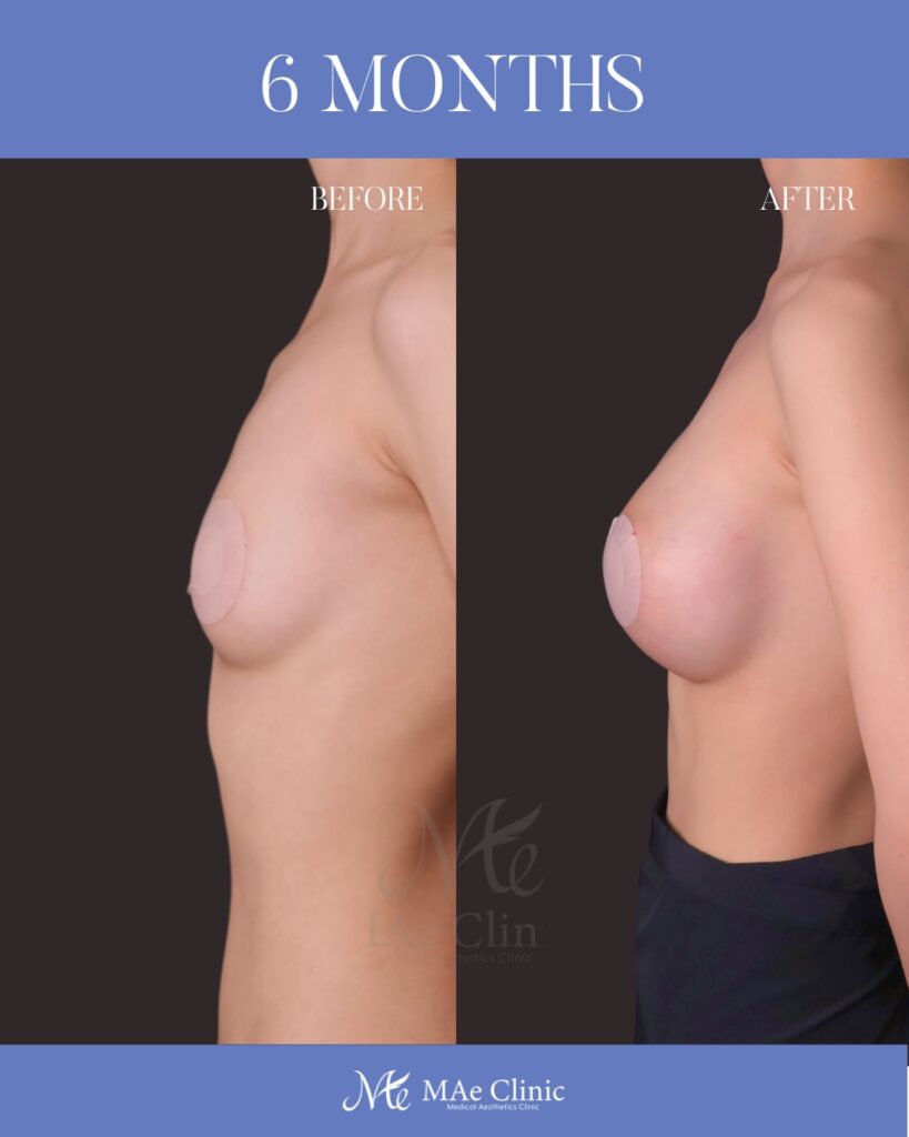 ハイブリッド豊胸 Motiva Ergonomix2（250ml）乳腺下留置 コンデンスリッチ脂肪注入（140ml） 木下恵里沙医師症例