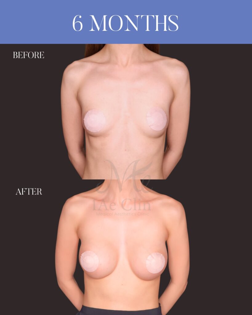 ハイブリッド豊胸 Motiva Ergonomix2（250ml）乳腺下留置 コンデンスリッチ脂肪注入（140ml） 木下恵里沙医師症例