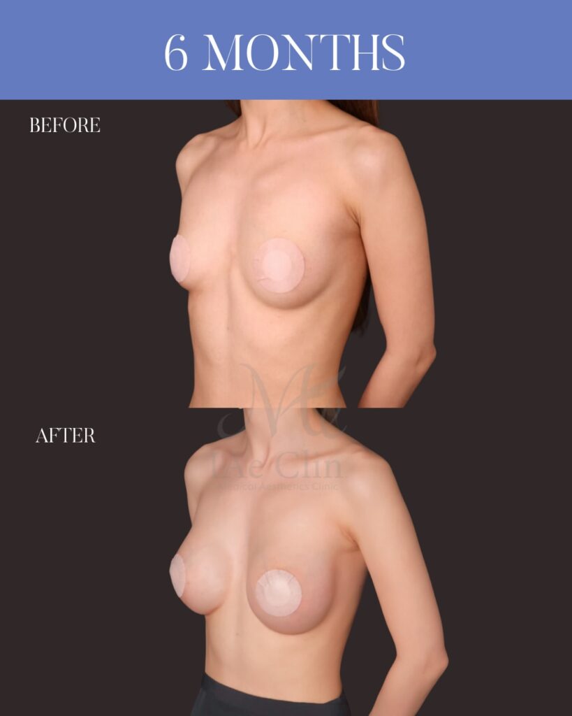 ハイブリッド豊胸 Motiva Ergonomix2（250ml）乳腺下留置 コンデンスリッチ脂肪注入（140ml） 木下恵里沙医師症例