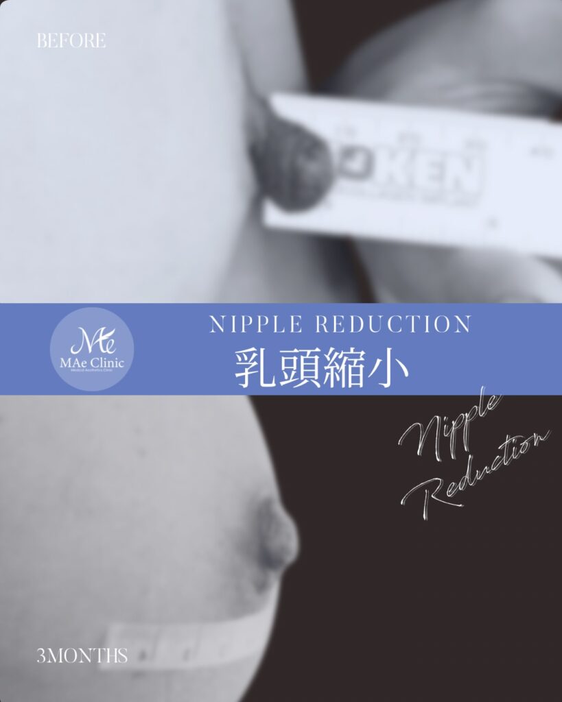 乳頭縮小
木下恵里沙医師症例