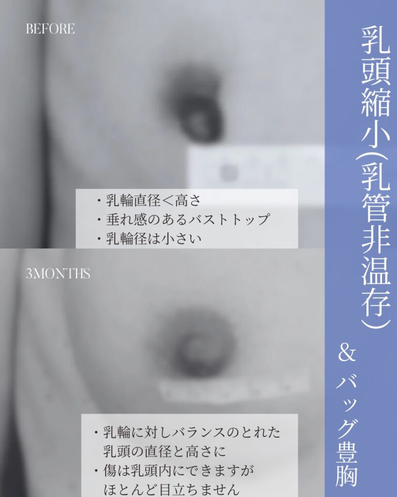 乳頭縮小 木下恵里沙医師症例