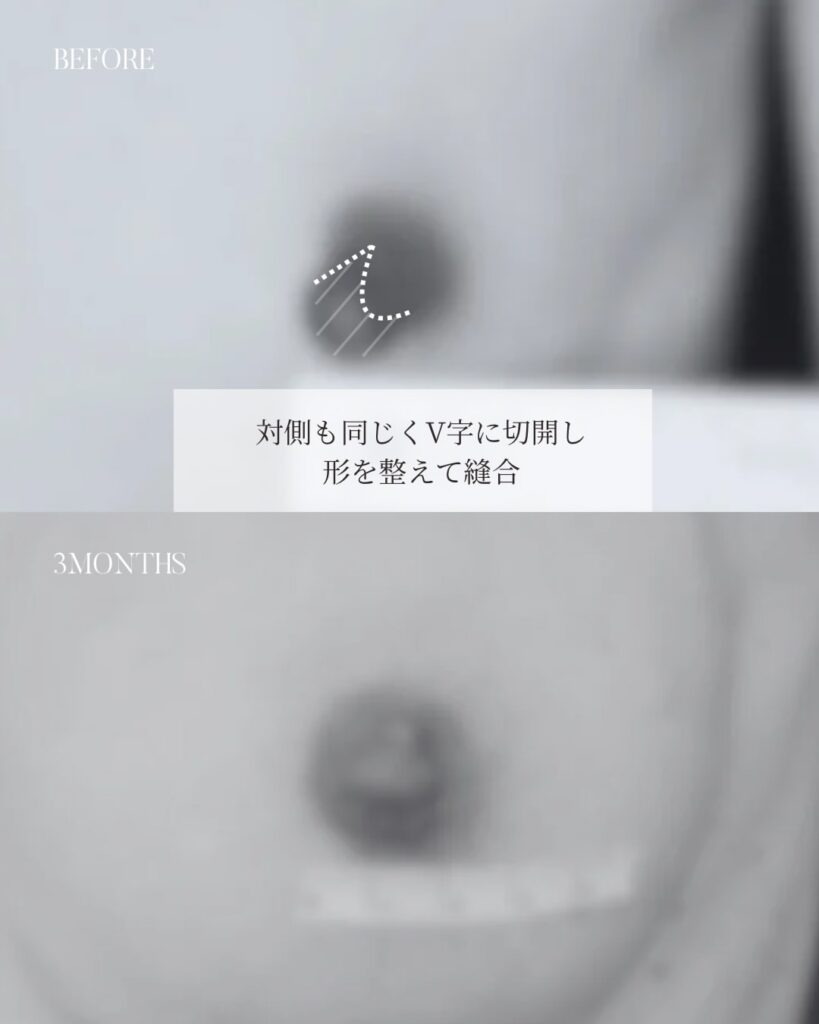 乳頭縮小 木下恵里沙医師症例