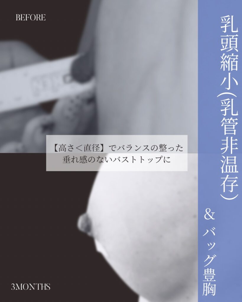 乳頭縮小 木下恵里沙医師症例