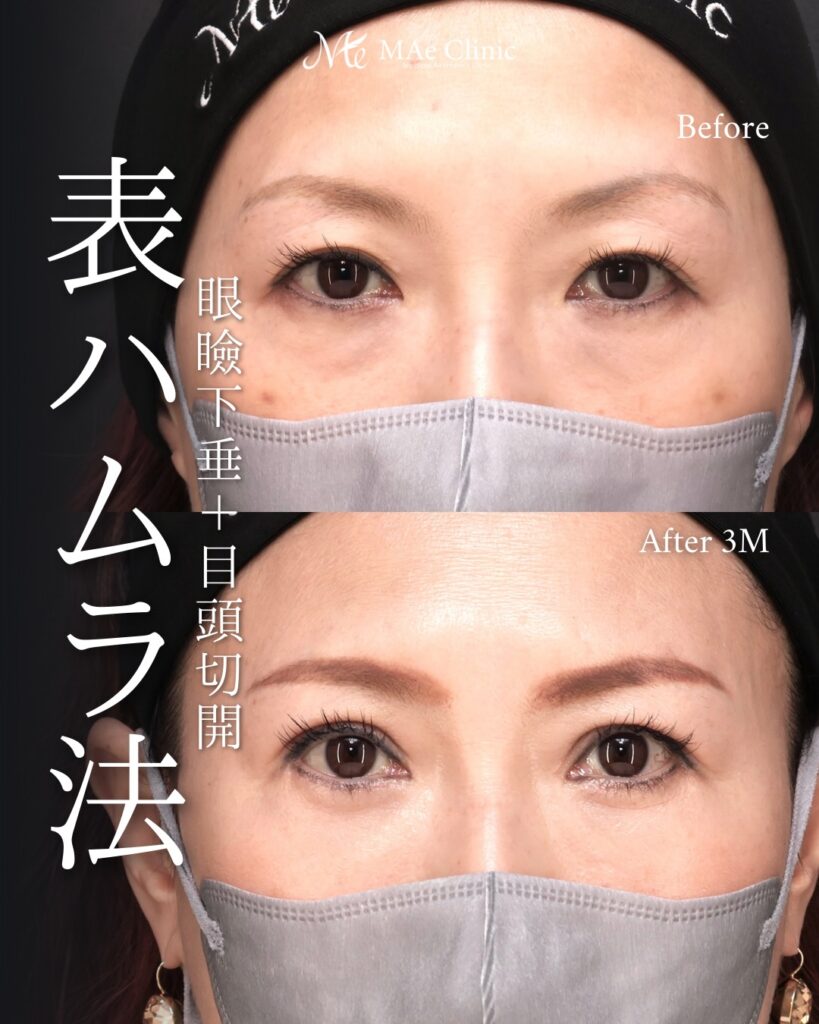 表ハムラ法(切開ハムラ) 眼瞼下垂手術 目頭切開 前之園健太医師症例