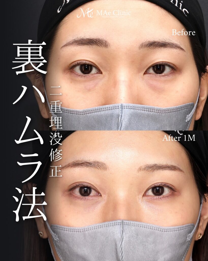 裏ハムラ法（経結膜下眼瞼形成術） 二重埋没法（修正） 前之園健太医師症例