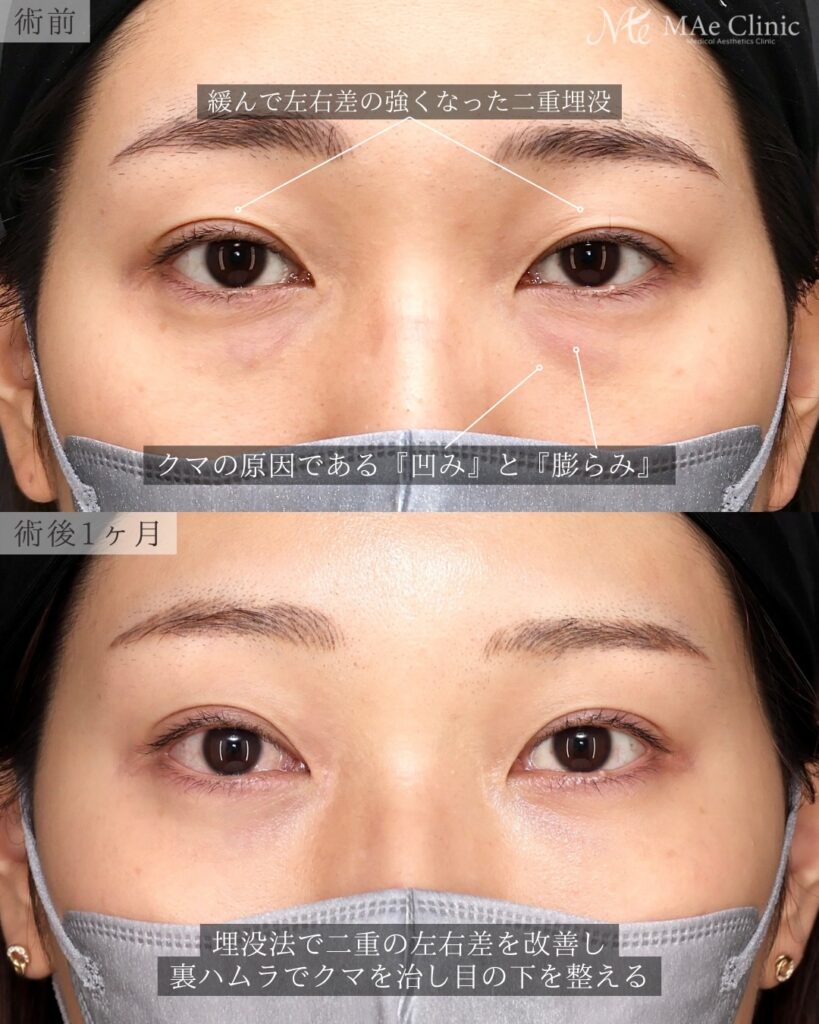 裏ハムラ法（経結膜下眼瞼形成術） 二重埋没法（修正） 前之園健太医師症例