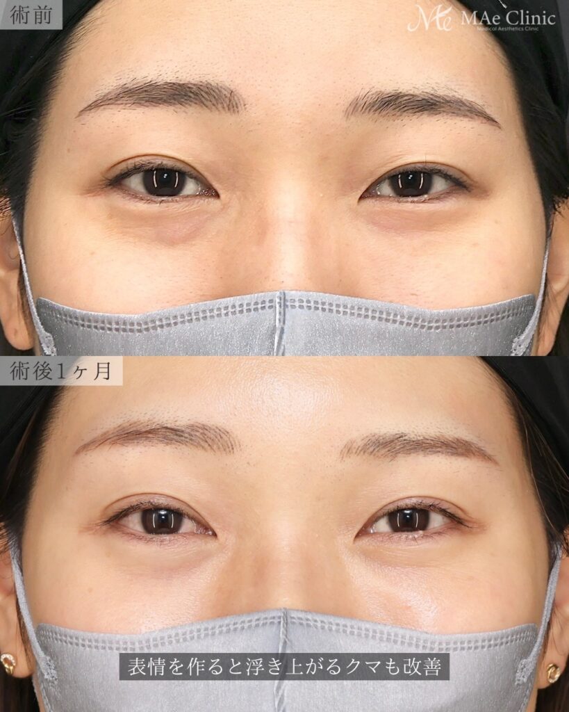 裏ハムラ法（経結膜下眼瞼形成術） 二重埋没法（修正） 前之園健太医師症例