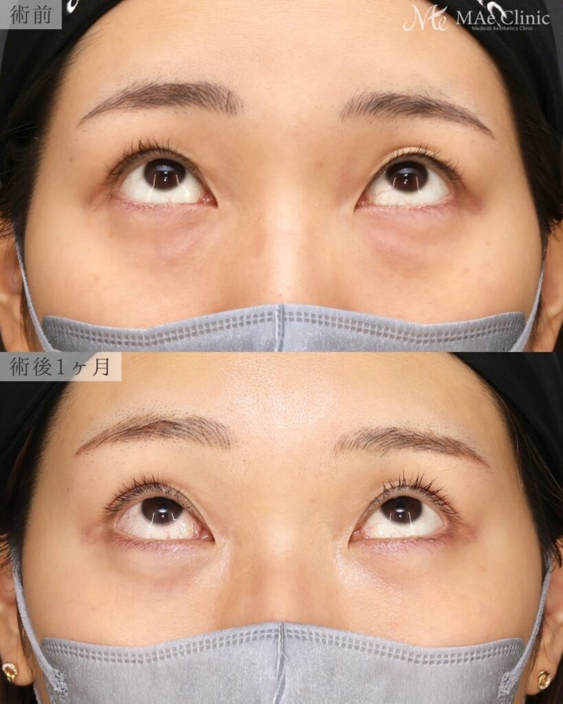 裏ハムラ法（経結膜下眼瞼形成術） 二重埋没法（修正） 前之園健太医師症例