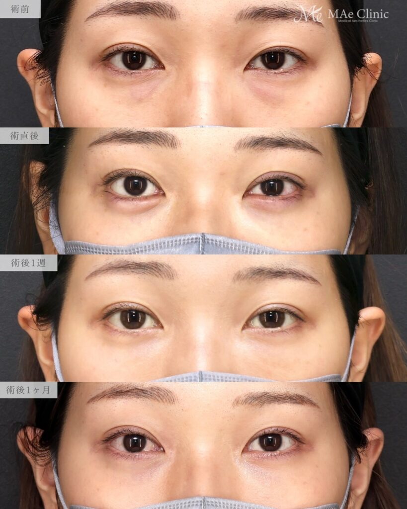 裏ハムラ法（経結膜下眼瞼形成術） 二重埋没法（修正） 前之園健太医師症例