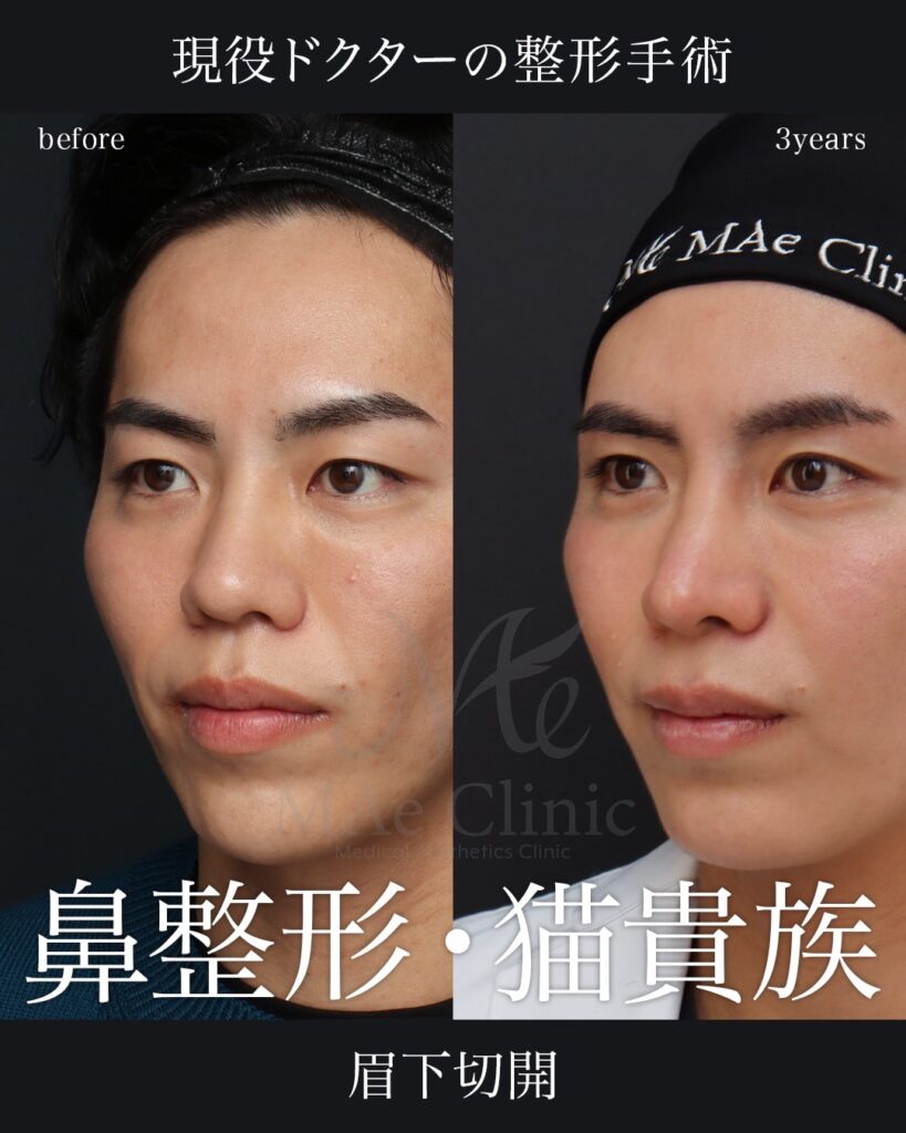鼻整形 猫貴族手術 眉下切開 前田翔医師症例