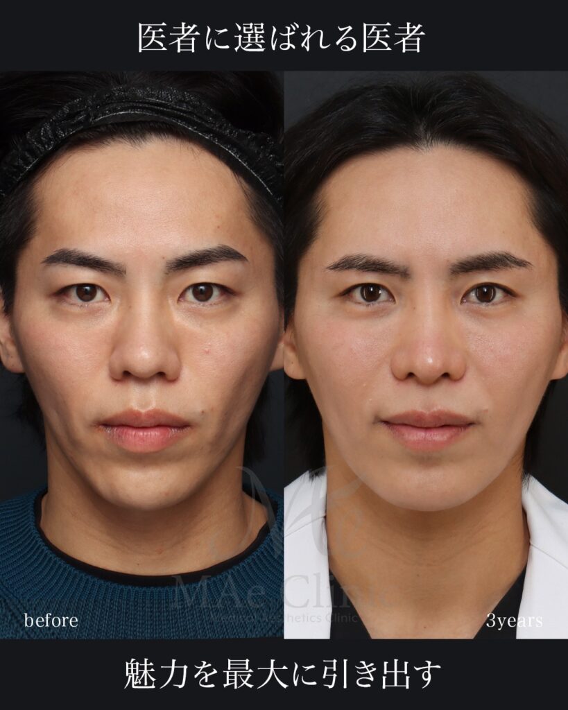 鼻整形 猫貴族手術 眉下切開 前田翔医師症例