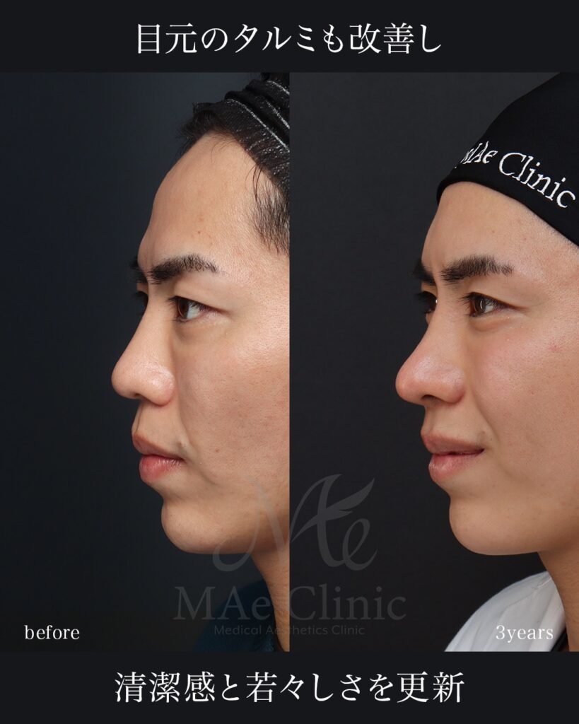 鼻整形 猫貴族手術 眉下切開 前田翔医師症例