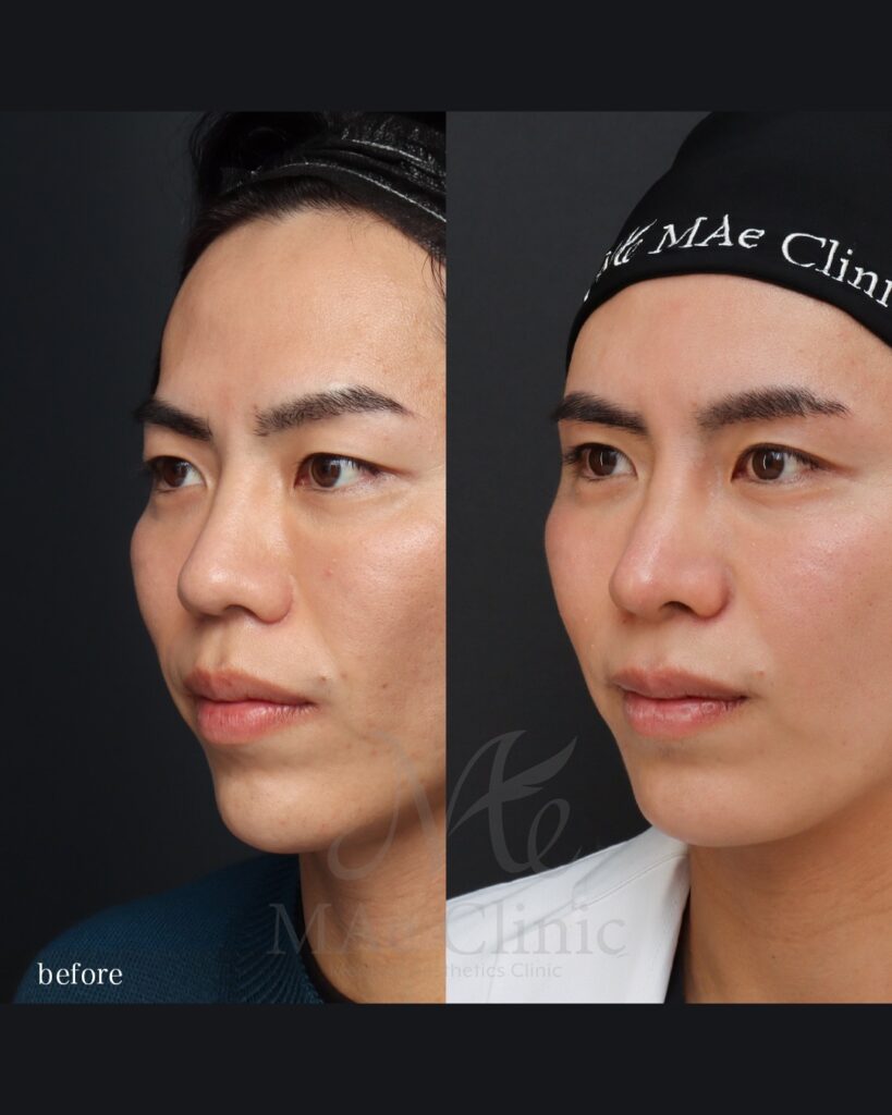 鼻整形 猫貴族手術 眉下切開 前田翔医師症例