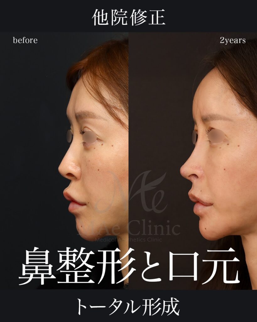 鼻中隔延長（肋軟骨） 鼻尖形成・鼻尖軟骨移植 鼻孔縁下降・土手再建 隆鼻（肋軟骨） 小鼻縮小（内側） 猫貴族手術（鼻翼基部・鼻柱基部移植） 裏人中短縮・3D厚み調整 脂肪注入（額） 前田翔医師症例