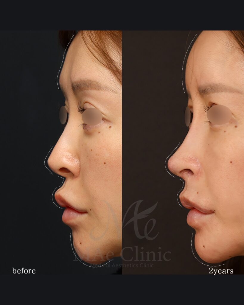 鼻中隔延長（肋軟骨） 鼻尖形成・鼻尖軟骨移植 鼻孔縁下降・土手再建 隆鼻（肋軟骨） 小鼻縮小（内側） 猫貴族手術（鼻翼基部・鼻柱基部移植） 裏人中短縮・3D厚み調整 脂肪注入（額） 前田翔医師症例