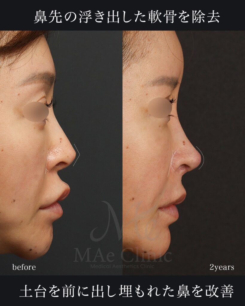 鼻中隔延長（肋軟骨） 鼻尖形成・鼻尖軟骨移植 鼻孔縁下降・土手再建 隆鼻（肋軟骨） 小鼻縮小（内側） 猫貴族手術（鼻翼基部・鼻柱基部移植） 裏人中短縮・3D厚み調整 脂肪注入（額） 前田翔医師症例