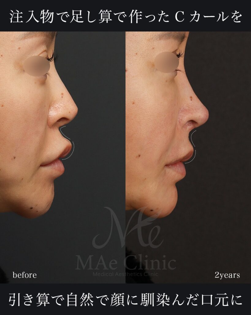 鼻中隔延長（肋軟骨） 鼻尖形成・鼻尖軟骨移植 鼻孔縁下降・土手再建 隆鼻（肋軟骨） 小鼻縮小（内側） 猫貴族手術（鼻翼基部・鼻柱基部移植） 裏人中短縮・3D厚み調整 脂肪注入（額） 前田翔医師症例