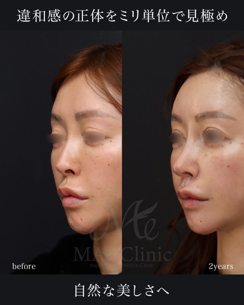 鼻中隔延長（肋軟骨） 鼻尖形成・鼻尖軟骨移植 鼻孔縁下降・土手再建 隆鼻（肋軟骨） 小鼻縮小（内側） 猫貴族手術（鼻翼基部・鼻柱基部移植） 裏人中短縮・3D厚み調整 脂肪注入（額） 前田翔医師症例