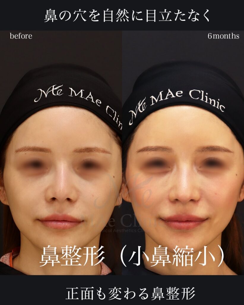 鼻中隔延長（肋軟骨） 鼻尖形成 鼻尖軟骨移植 小鼻縮小 ハンプ切除 鼻孔縁挙上 望月正人医師症例