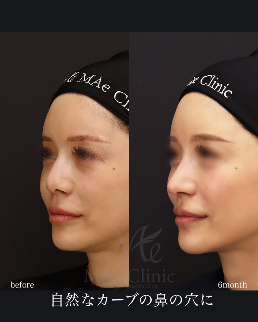 鼻中隔延長（肋軟骨） 鼻尖形成 鼻尖軟骨移植 小鼻縮小 ハンプ切除 鼻孔縁挙上 望月正人医師症例