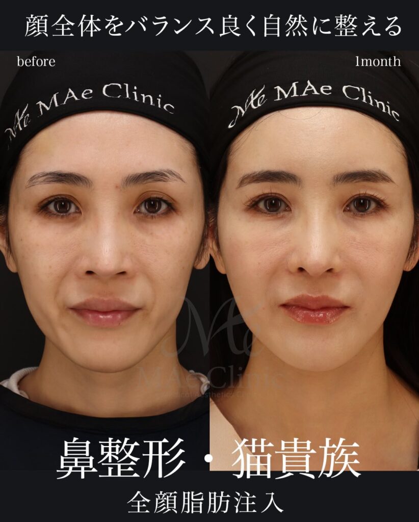 鼻中隔延長（肋軟骨による再建） 鼻尖形成・鼻尖軟骨移植 猫貴族手術（肋軟骨移植） 全顔脂肪注入 望月正人医師症例