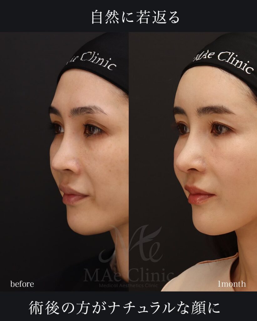 鼻中隔延長（肋軟骨による再建） 鼻尖形成・鼻尖軟骨移植 猫貴族手術（肋軟骨移植） 全顔脂肪注入 望月正人医師症例