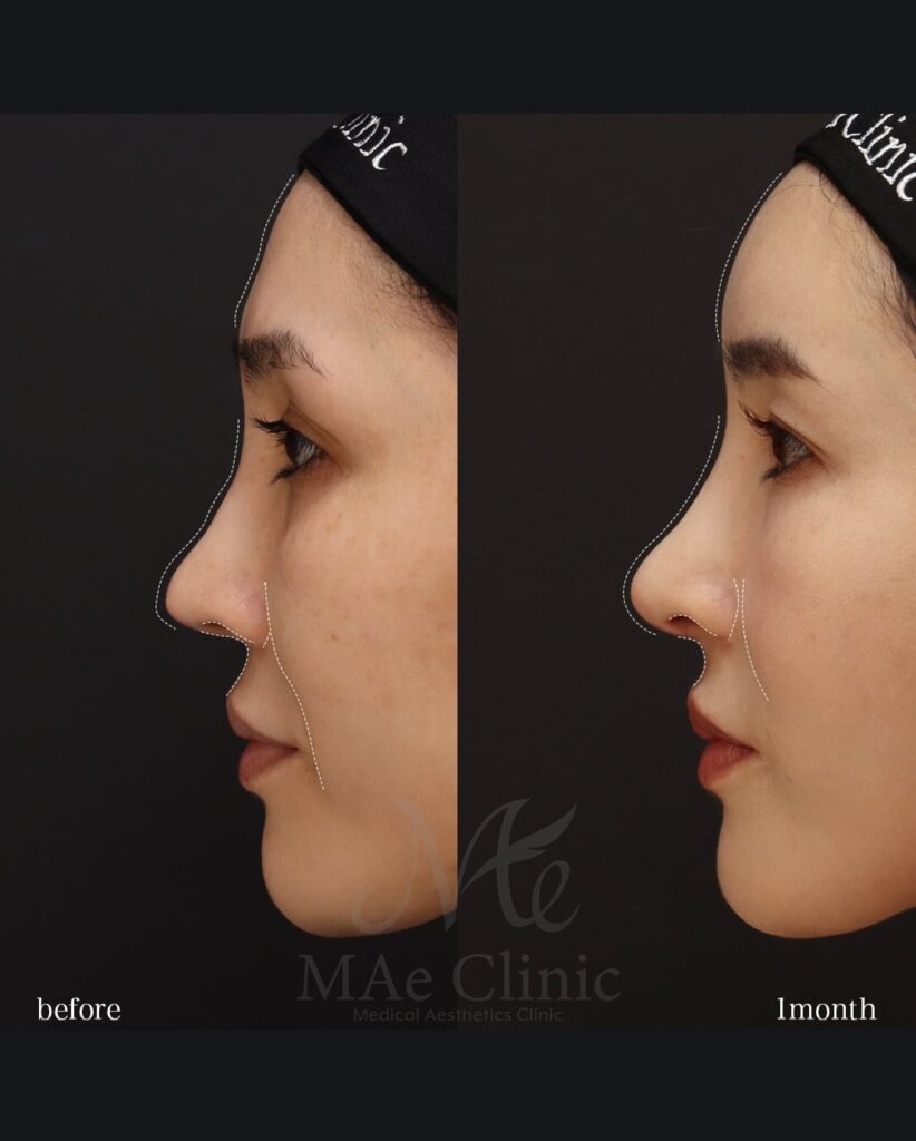 鼻中隔延長（肋軟骨による再建） 鼻尖形成・鼻尖軟骨移植 猫貴族手術（肋軟骨移植） 全顔脂肪注入 望月正人医師症例