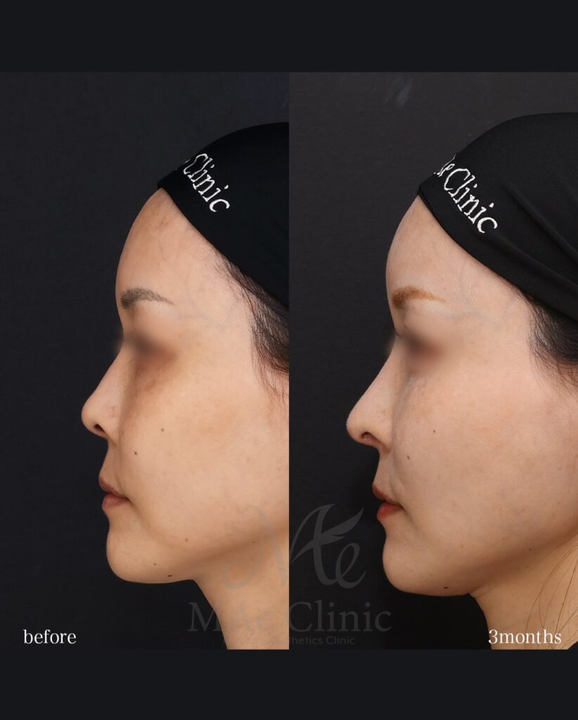 鼻フル（鼻中隔延長、鼻尖形成、鼻尖軟骨移植） 猫貴族手術 望月正人医師症例