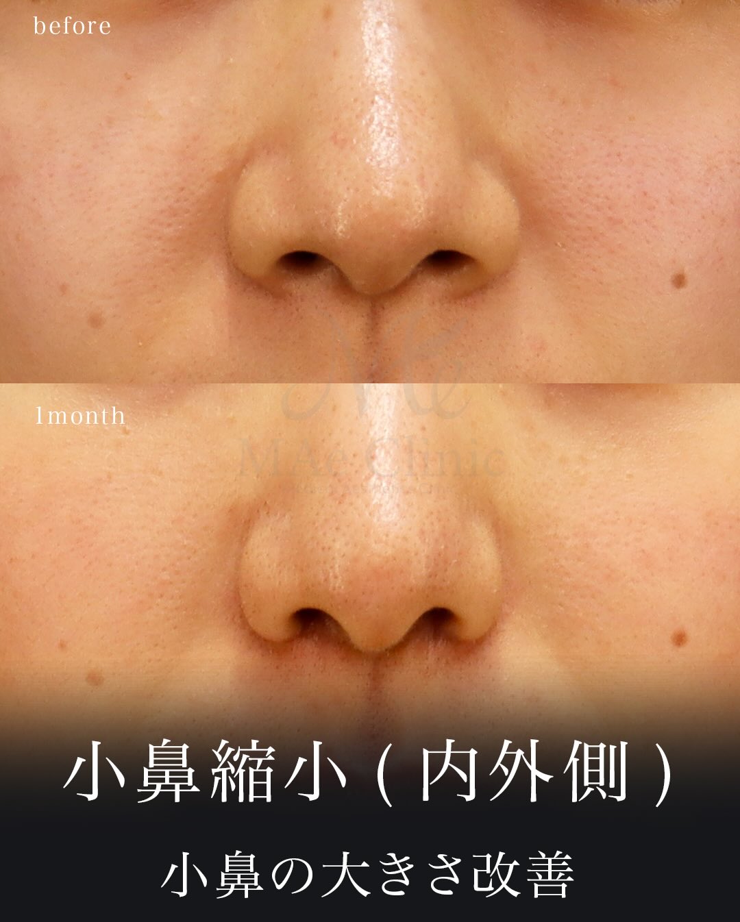 小鼻縮小（内外側法）で広がりを解消。大きな手術をせず鼻を小さく